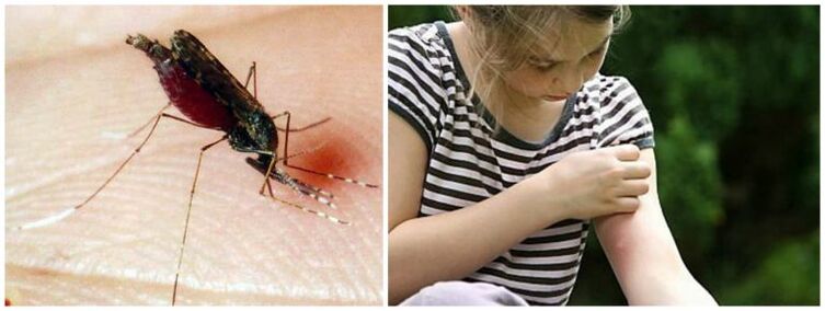 Sāpīgi gabali pēc moskītu koduma var būt sirdstārpu simptoms