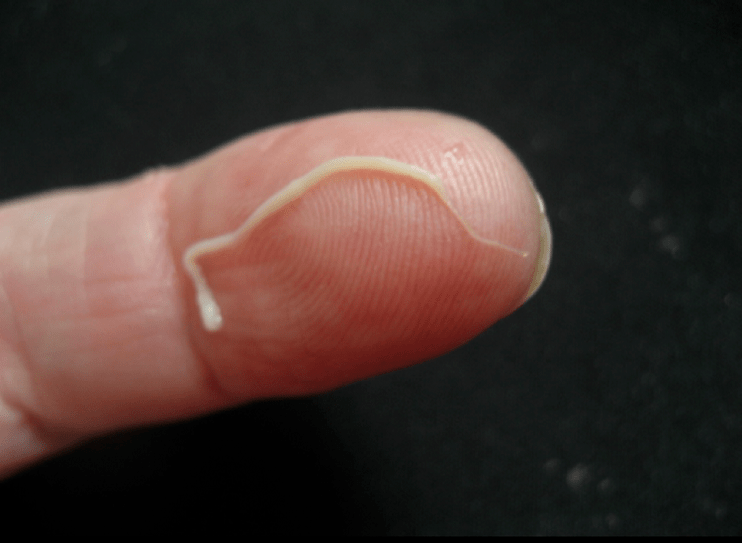 apaļtārpu parazīts no cilvēka ķermeņa